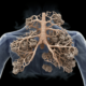 False Diagnosis of Emphysema