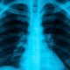False Diagnosis of Emphysema: Unveiling the Truth