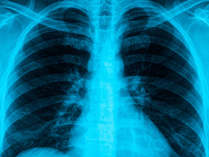 False Diagnosis of Emphysema: Unveiling the Truth